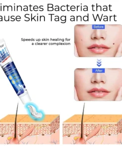Bikenda® Mole and Wart Removal Laser Set
