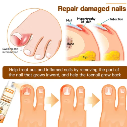 Cvreoz™ Bee Venom Nail Fungus Spray