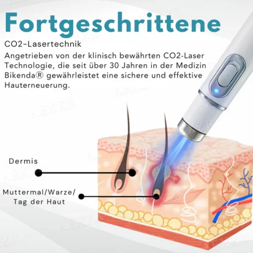 Bikenda® Nicht-invasiv Leberfleck- und Warzenentfernungs-Laserstift