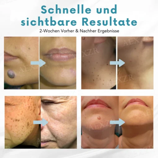Bikenda® Nicht-invasiv Leberfleck- und Warzenentfernungs-Laserstift