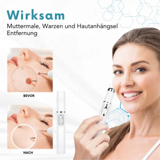 Bikenda® Nicht-invasiv Leberfleck- und Warzenentfernungs-Laserstift