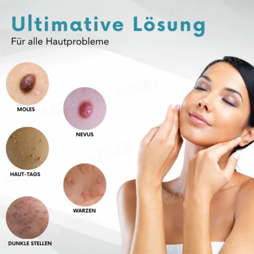 Bikenda® Nicht-invasiv Leberfleck- und Warzenentfernungs-Laserstift