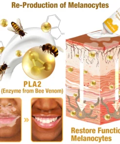 Vitiligo Treatment Cream