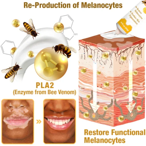 Vitiligo Treatment Cream