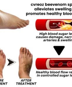 CVREOZ® Bee Venom Diabetic Foot Treatment Spray