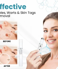 LAOZIK® Non-Invasive Mole and Wart Removal Laser Pen