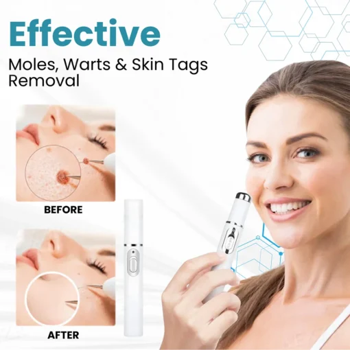 LAOZIK® Non-Invasive Mole and Wart Removal Laser Pen