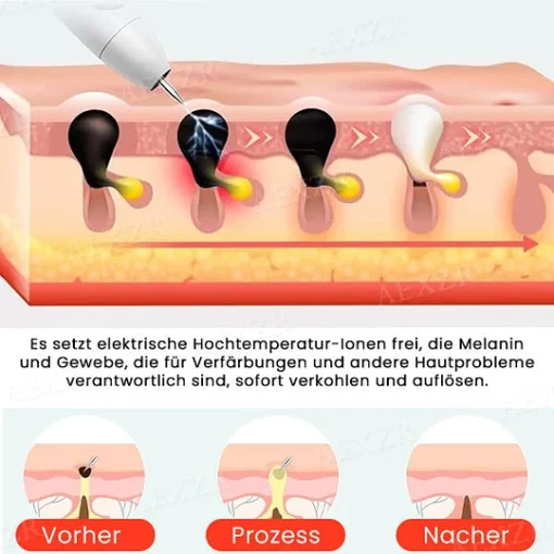 Fivfivgo™ Portable Skin Care Laser Pen