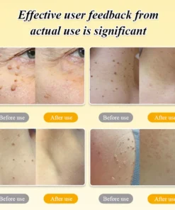 BOOMOON Bee Venom Wart Treatment Spray