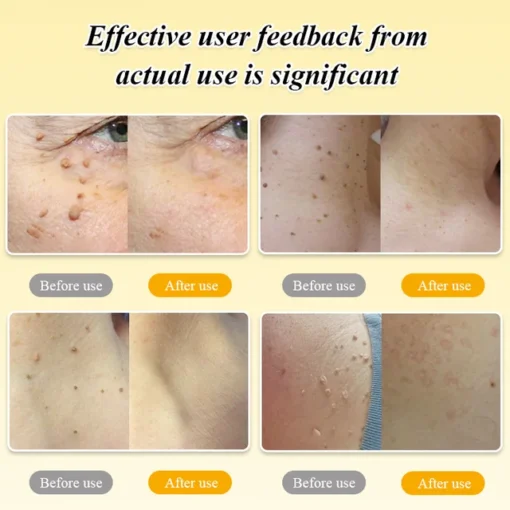 BOOMOON Bee Venom Wart Treatment Spray