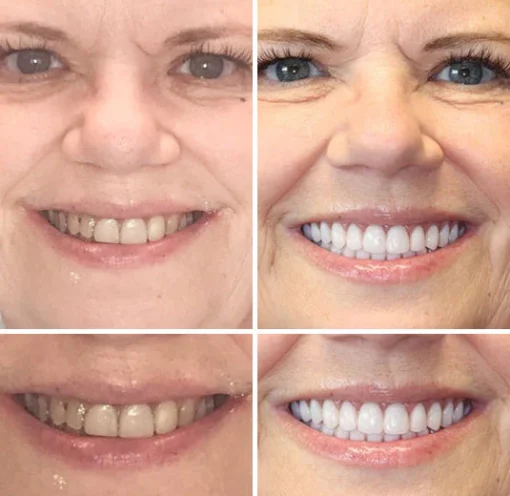 Natravor™ - Dentadura Premium