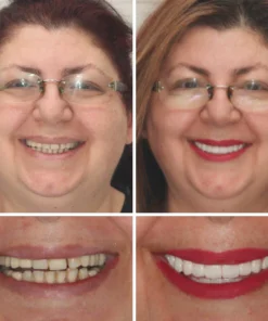 Natravor™ - Dentadura Premium