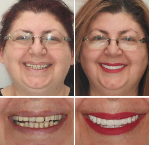 Natravor™ - Dentadura Premium