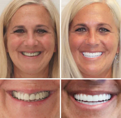 Natravor™ - Dentadura Premium