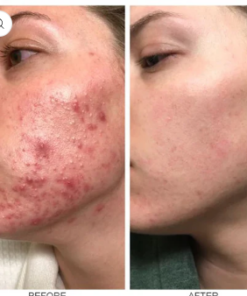 LIMETOW™ herbal acne removal cream