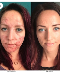 LIMETOW™ herbal acne removal cream
