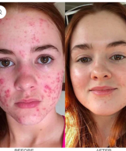 LIMETOW™ herbal acne removal cream