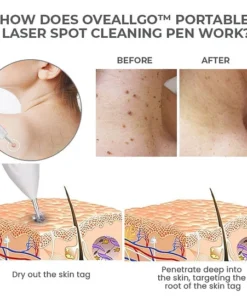 Fivfivgo™ Portable Laser Spot Cleaning Pen