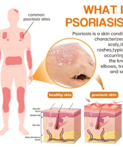 LOVILDS™ PsoriaHeal Psoriasis Spray