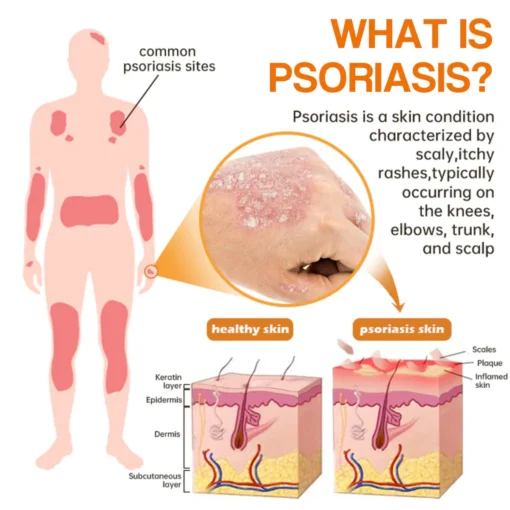 LOVILDS™ PsoriaHeal Psoriasis Spray