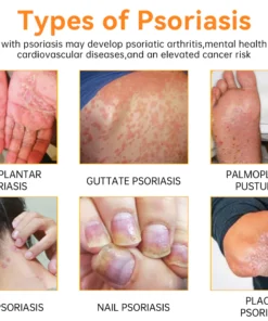 LOVILDS™ PsoriaHeal Psoriasis Spray