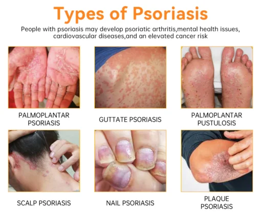 LOVILDS™ PsoriaHeal Psoriasis Spray