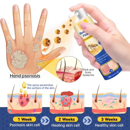 LOVILDS™ PsoriaHeal Psoriasis Spray