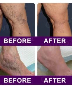Cvreoz® Polidocanol Nano Patches for Varicose Veins