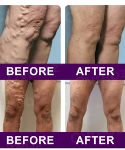 Cvreoz® Polidocanol Nano Patches for Varicose Veins