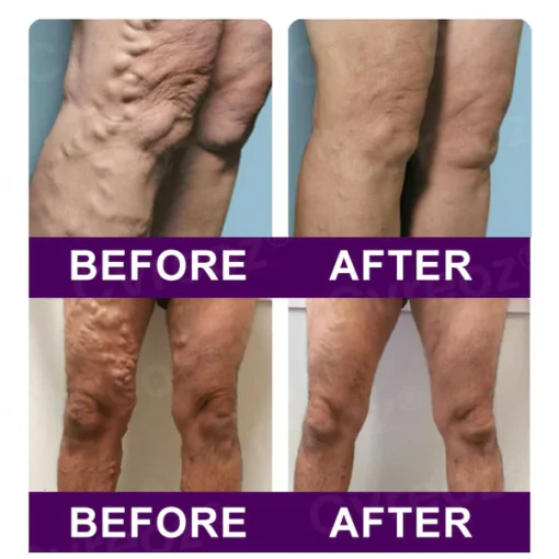 Cvreoz® Polidocanol Nano Patches for Varicose Veins