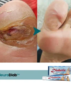NeuroDiab™ Diabetic Nerve Cream