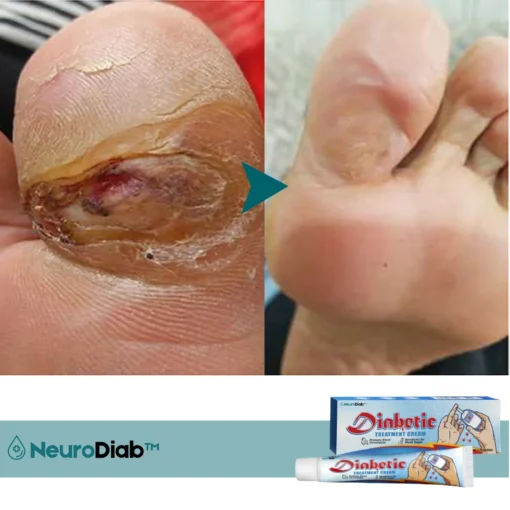 NeuroDiab™ Diabetic Nerve Cream