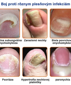 Furzero™ Bee Venom for Nail Fungus