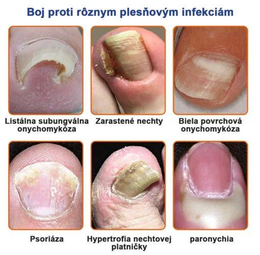Furzero™ Bee Venom for Nail Fungus