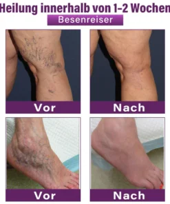 Fubsta® Polidocanol Nano Patches for Varicose Veins