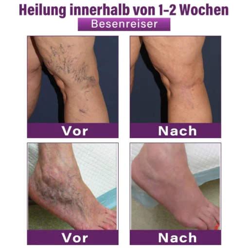 Fubsta® Polidocanol Nano Patches for Varicose Veins
