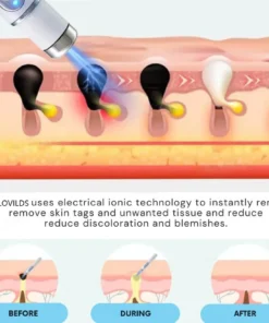 LOVILDS™ Non-Invasive Mole and Wart Removal Laser Pen