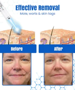 Bikenda® DermZap Mole & Wart Removal Laser Pen