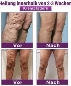 Fubsta® Polidocanol Nano Patches for Varicose Veins