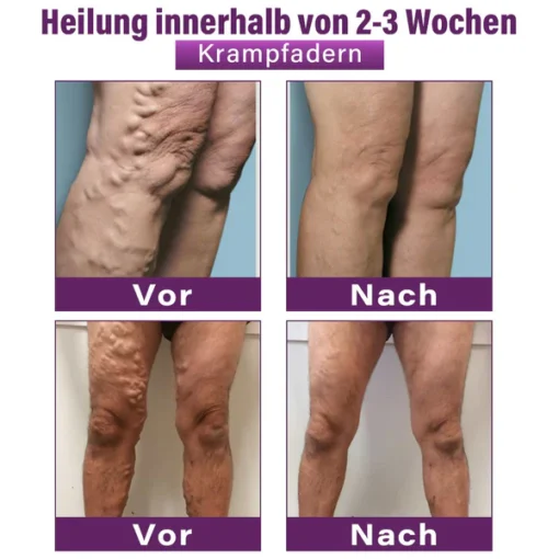 Fubsta® Polidocanol Nano Patches for Varicose Veins