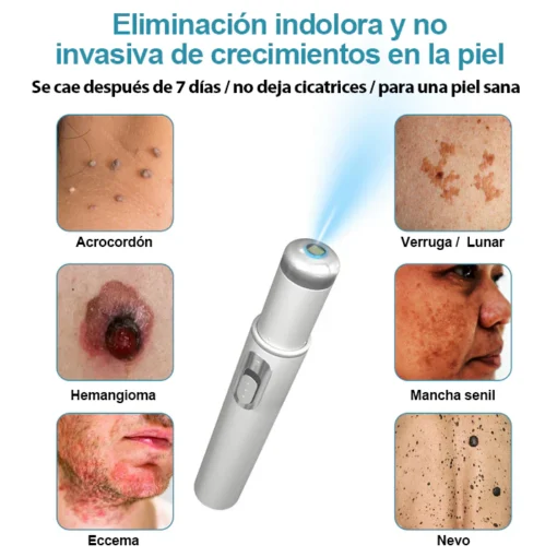 Non-invasive laser pen for mole and wart removal (atravor™)