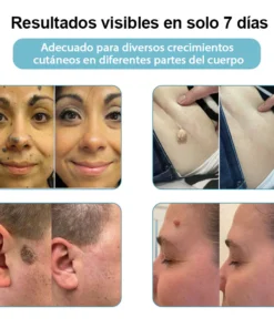 Non-invasive laser pen for mole and wart removal (atravor™)