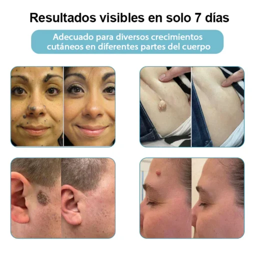 Non-invasive laser pen for mole and wart removal (atravor™)