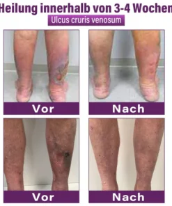 Fubsta® Polidocanol Nano Patches for Varicose Veins