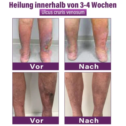 Fubsta® Polidocanol Nano Patches for Varicose Veins