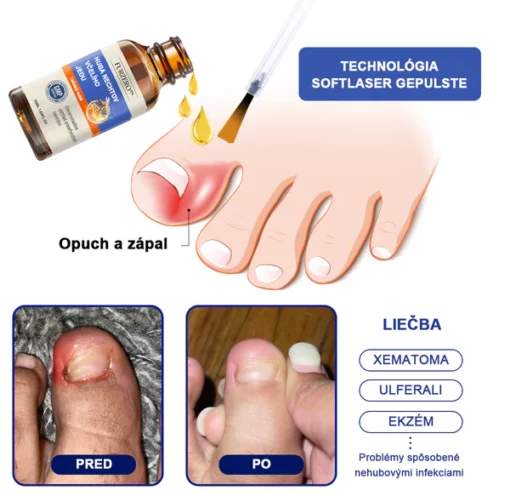 Furzero™ Bee Venom for Nail Fungus