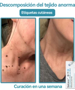 Non-invasive laser pen for mole and wart removal (atravor™)
