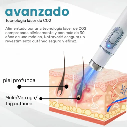 Non-invasive laser pen for mole and wart removal (atravor™)