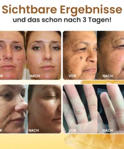 Dobshow® Bee Venom Warts & Moles Removal