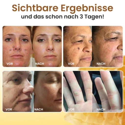 Dobshow® Bee Venom Warts & Moles Removal